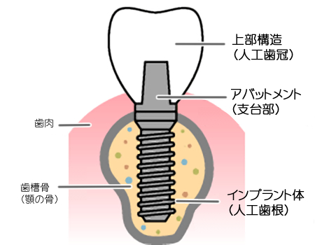 インプラント