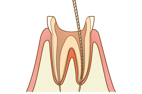 むし歯・根管治療